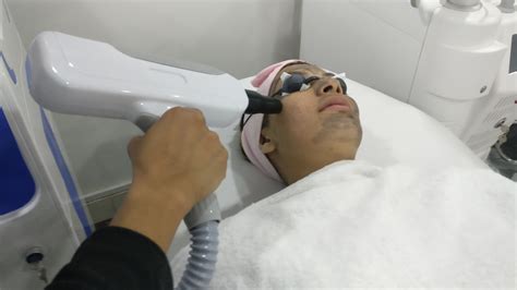 Carbon Laser Facial Treatment Procedure Bodevolution