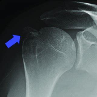 Anteroposterior Radiograph View Of The Right Shoulder Demonstrating A