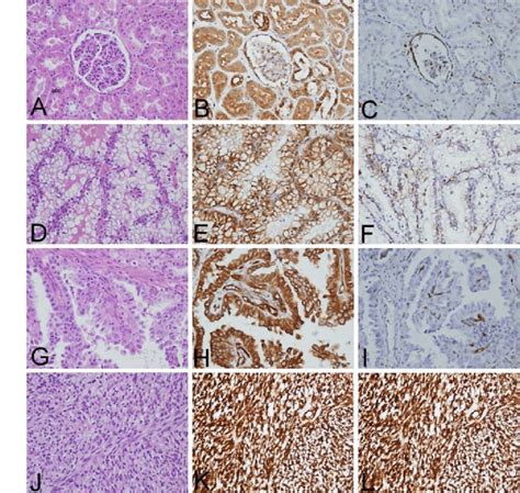 H E Staining Of Normal Renal Tissue A Clear Cell Rcc Crcc D