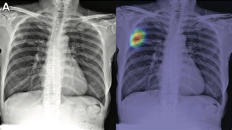 Deep Learning Classification Of Active Tuberculosis Lung 50 Off