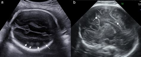 Fetal Neurosonography As Accurate Tool For Diagnosis Of Brain