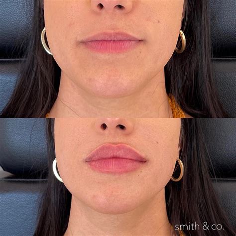 Lip Injection Before After Gallery Artofit