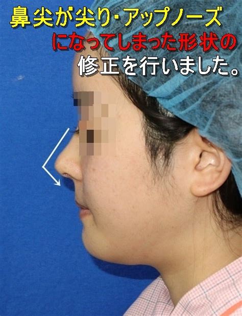 不自然に尖った鼻尖を修正手術 やまくり女子すたっふの美的日常