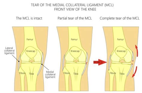 Medial Collateral Ligament Mcl Injury Mundaring And Hills