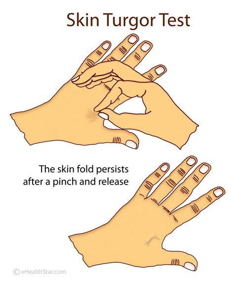 Normal And Poor Skin Turgor Definition Assessment Scale Ehealthstar