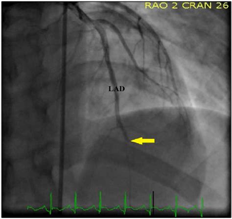 Coronary Angiogram Anteroposterior Cranial View Showing Distal Left