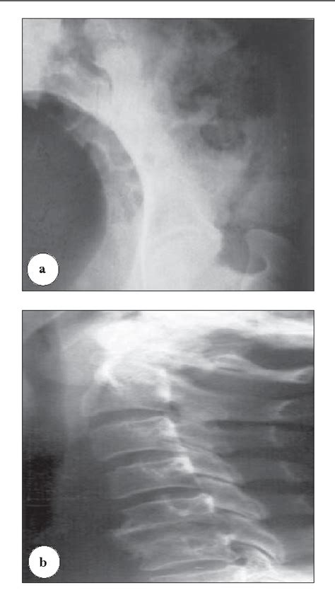 Figure 1 From Fracture Of The Anterior Iliac Crest Following Autogenous Bone Grafting