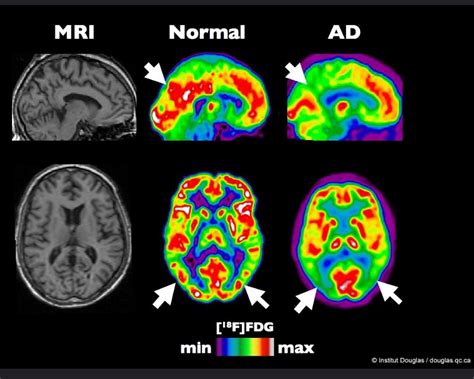 La FDA approva un nuovo farmaco per l Alzheimer che può rallentare il