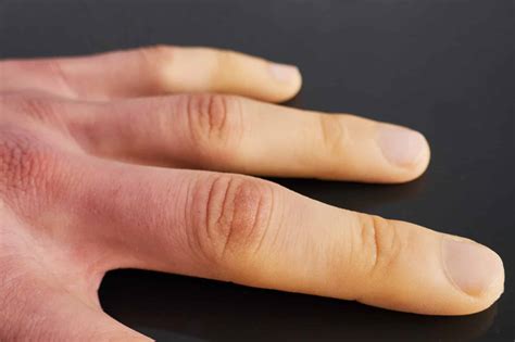 Sindrome di Raynaud cos è cause e trattamenti CUENEWS