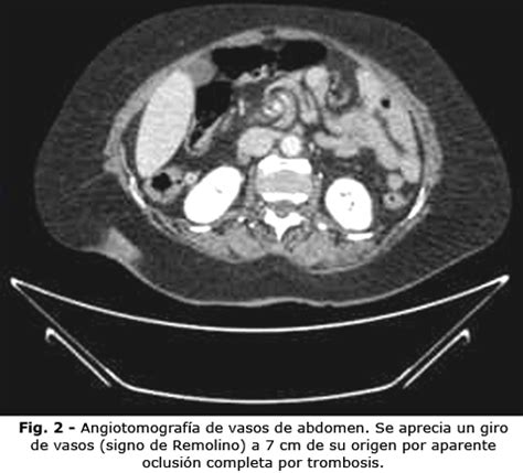 Remolinos mesentéricos en la angiotomografía de paciente con hernia de