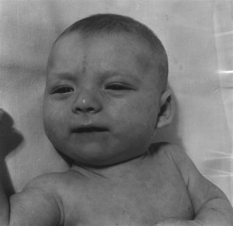 Синдром Вольфа-Хиршхорна