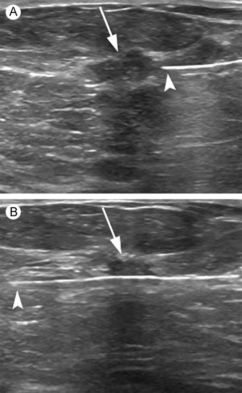 Ultrasound Guided Percutaneous Breast Biopsy Techniques In Vascular