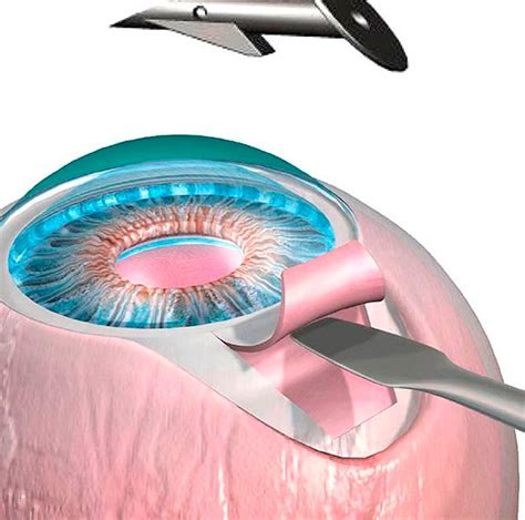 Cirurgia De Glaucoma Instituto De Olhos Minas Gerais