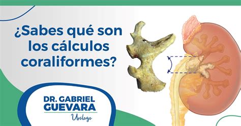 C Lculos Coraliformes C Mo Se Forman Alternativas De Tratamiento