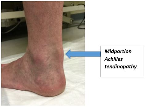 Achilles Tendinopathy Achilles Tendinitis Diagnosis 52 Off