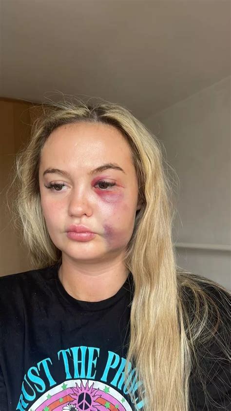 Scots Woman Beaten Black And Blue And Left Unconscious By Strangers At