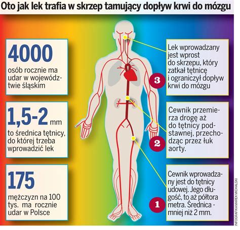 Sposób na udar mózgu nowatorska operacja w Katowicach Dziennik Zachodni