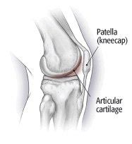 Chondromalacia Patella Guide Causes Symptoms And Treatment Options