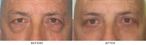 Ptosis Surgery Before and After Photo Gallery