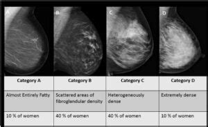 The Connection Between Dense Breasts And Breast Cancer Patricia