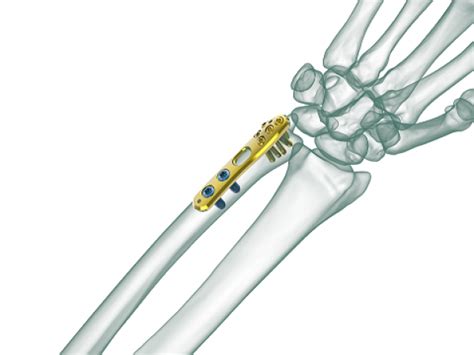 TRUE Distal Ulna Anatomic Locking Plate TRUEMED Medikal