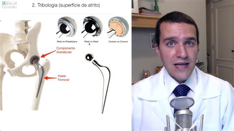 Quanto Tempo Dura Uma Pr Tese De Quadril Qual A Melhor Pr Tese De