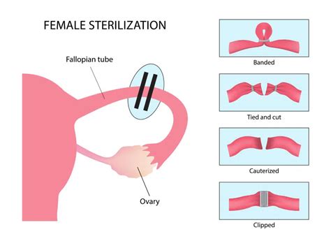 Male And Female Sterilization Procedures And Side Effects