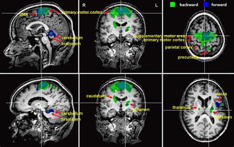 Supplementary Motor Area Mri