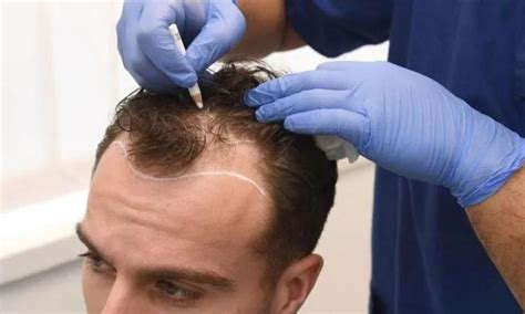 Fue Hair Transplant Malaysia Professional And Best Price