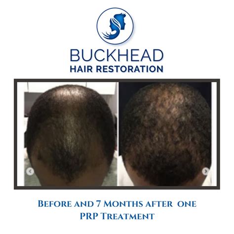 Prp Gallery Before And After Prp Hair Restoration In Buckhead Atlanta