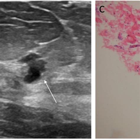 Extracapsular Silicone Breast Implant Rupture 58 Year Old Woman With