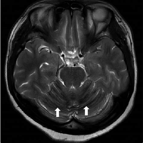 Magnetic Resonance Imaging T2 Weighted Image Shows Low Signal