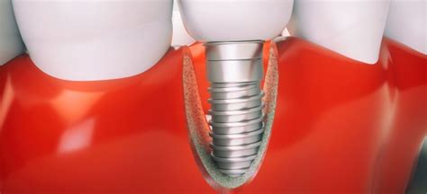 Peri Implantitis Successfully Treated With New Procedure Uk