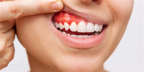 How To Stop Bleeding Gums Canberry Dental