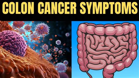 6 Early Warning Signs Of Colon Cancer You Shouldn T Ignore Youtube