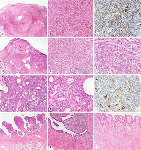 A Histopathological Findings From The Black Node Showing Tumor Nests