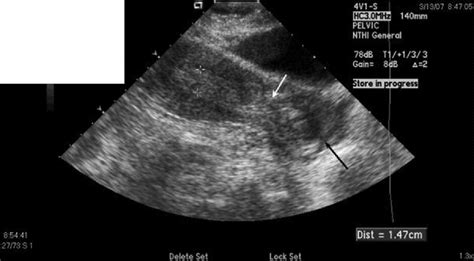 Emergency Ultrasound In Cervical Ectopic Pregnancy Journal Of Emergency Medicine