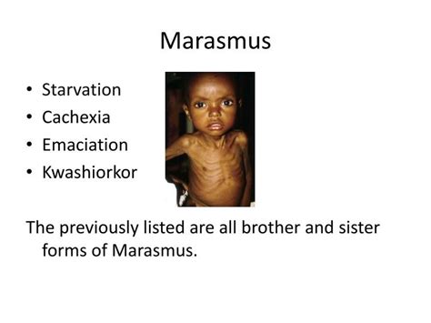 PPT - Marasmus PowerPoint Presentation - ID:2037853