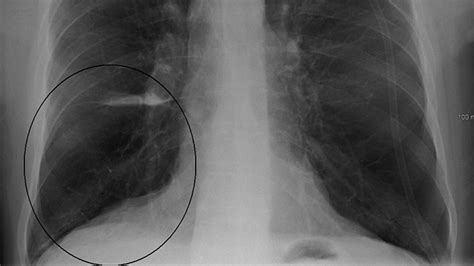 Normal Chest X Ray Vs COPD