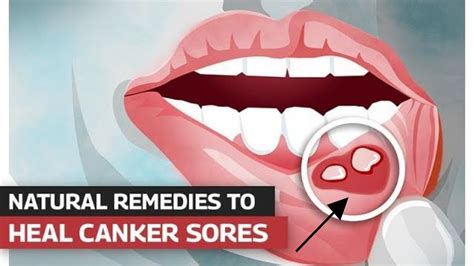 How To Treat Canker Sores Mouth Sores Treatment YouTube