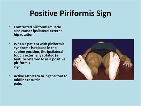 Piriformis Syndrome Physical Therapy Student Massage Therapy School