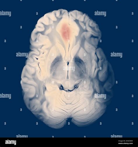 Anatomia Tc Encefalo Immagini E Fotografie Stock Ad Alta Risoluzione