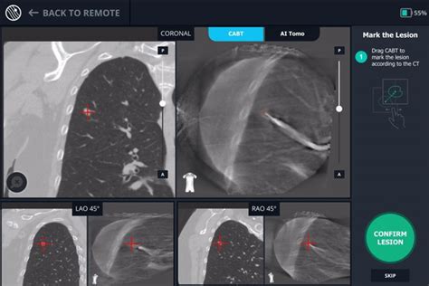 Overcoming Ct To Body Divergence To Biopsy Definitively Diagnose And