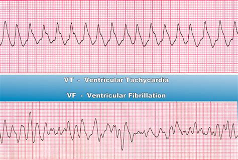 Ventricular Tachycardia Ventricular Fibrillation Stock Photo Download