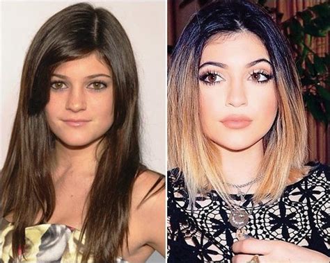 Kylie Jenner Plastische Chirurgie Vorher Und Nachher Chirurgie Jenner