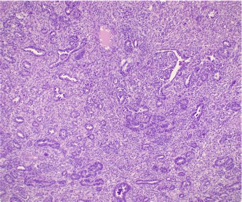 Figure 2 From Primary Testicular Teratoid Wilms Tumor In A 40 Year Old