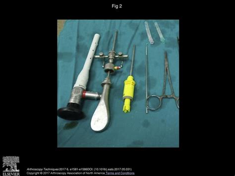 Arthroscopic Treatment Of Type 1b Triangular Fibrocartilage Complex Tear By “outside In” Repair