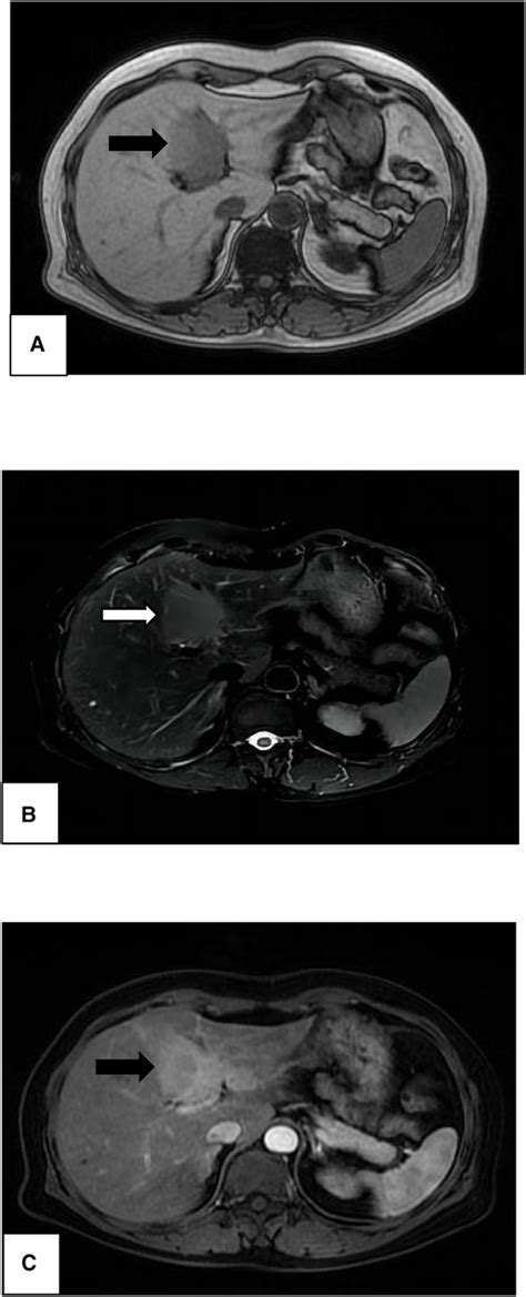 Frontiers Primary Hepatic Lymphoma Of Malt Type Mimicking Hepatic