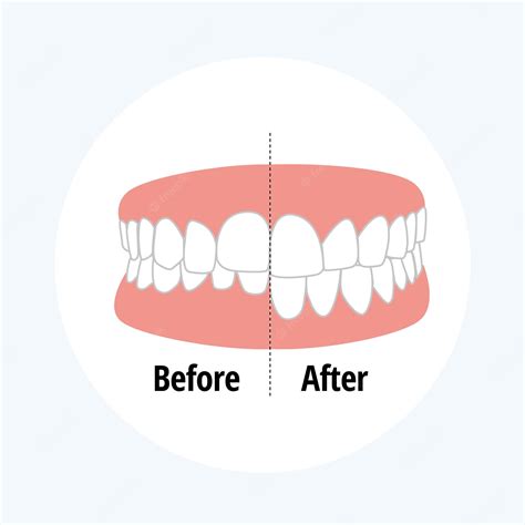 Overbite Malocclusion