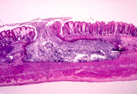 Entamoeba Histolytica Anchovy Paste